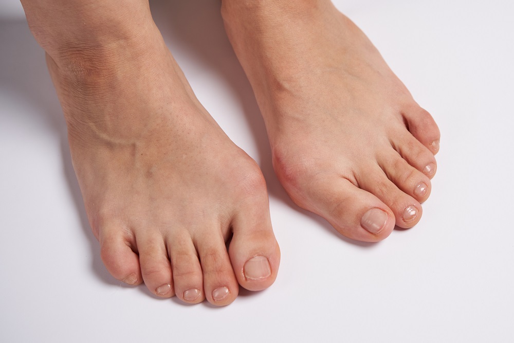 вылезла косточка на ноге - ортопед-травматолог Одесса